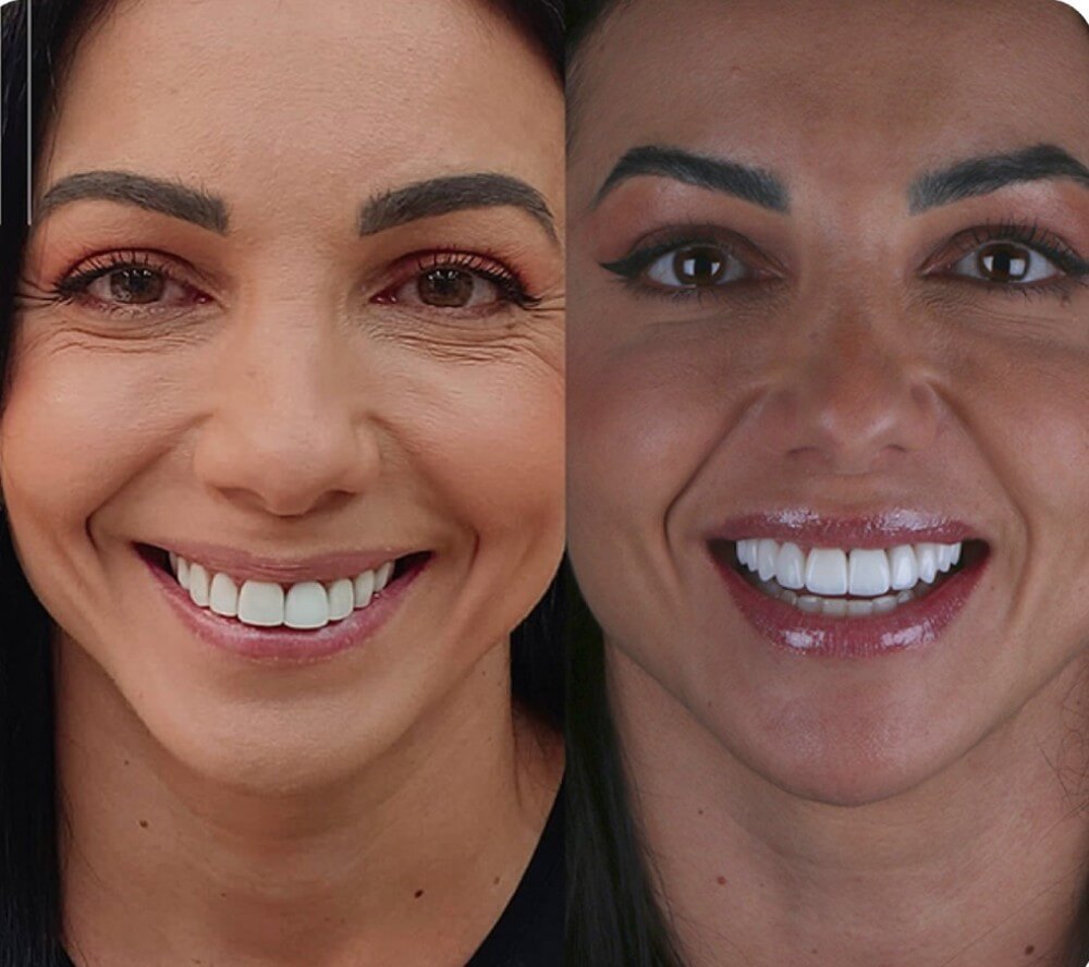 Antes e Depois Facetas de Porcelana