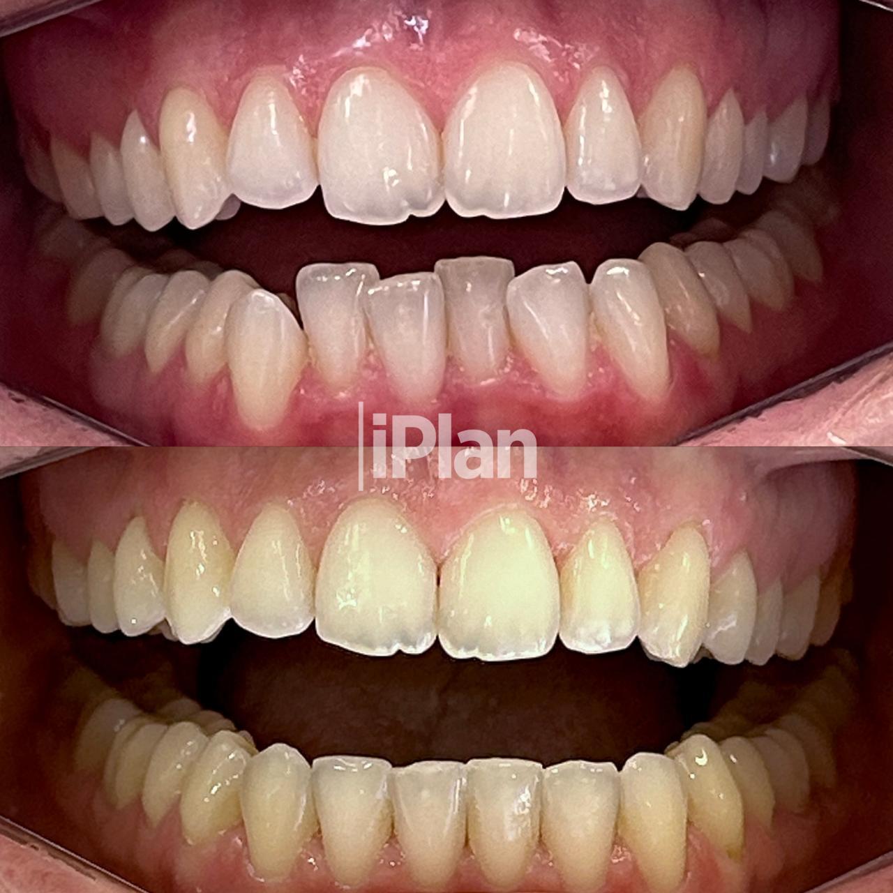 Resultado Invisalign