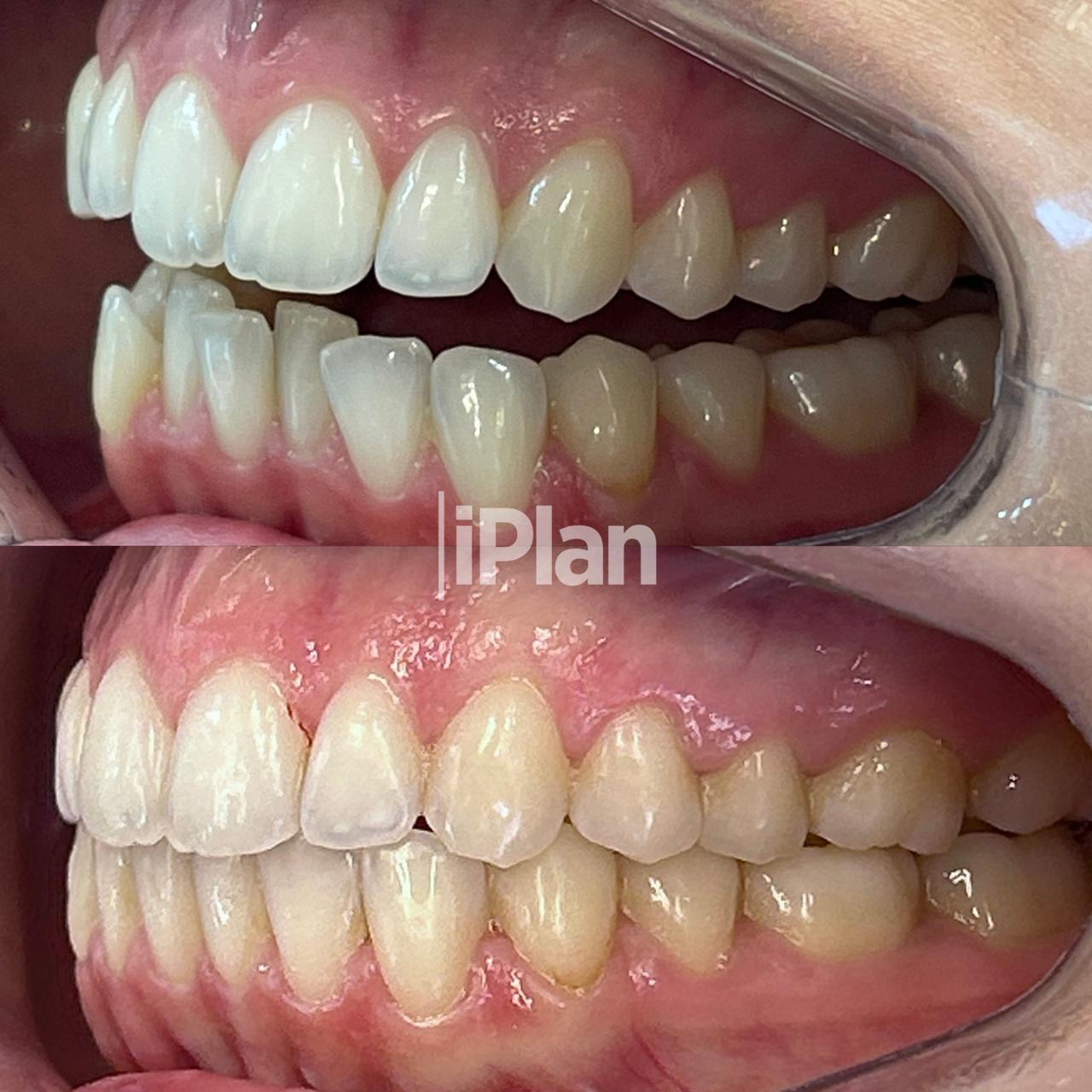 Resultado Invisalign