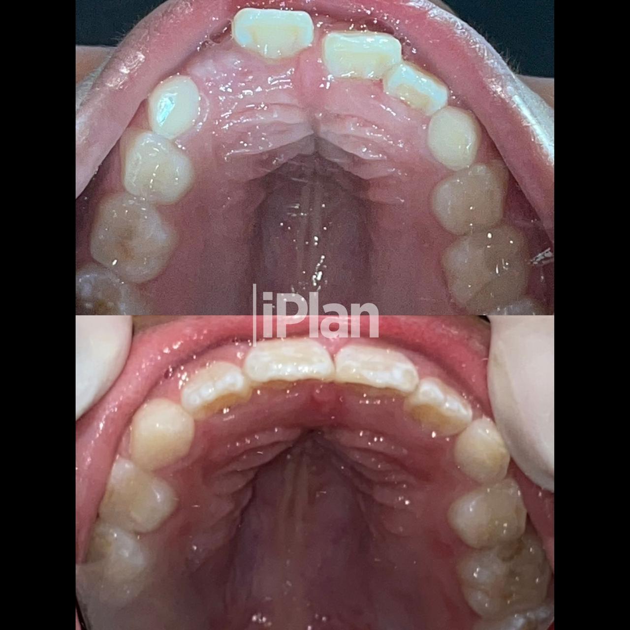 Resultado Invisalign