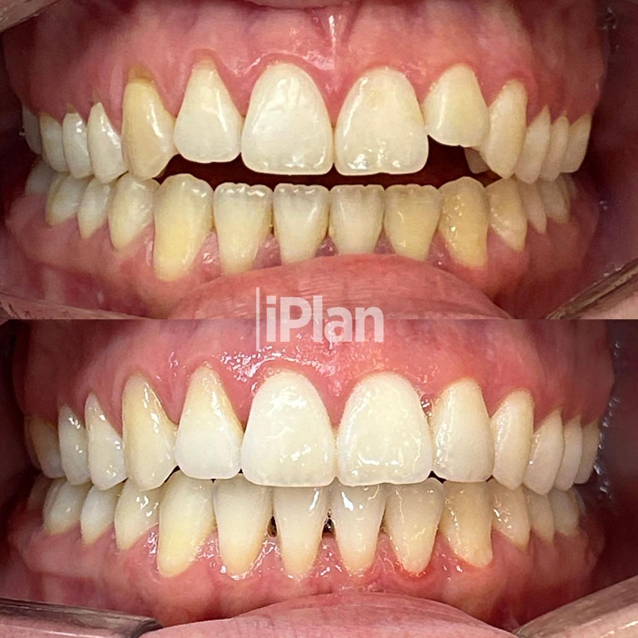 Resultado Invisalign