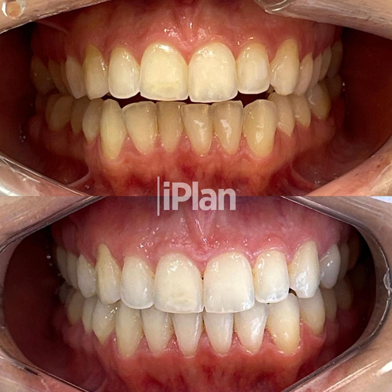 Resultado Invisalign