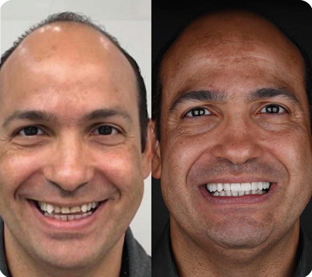 Antes e Depois Facetas de Porcelana