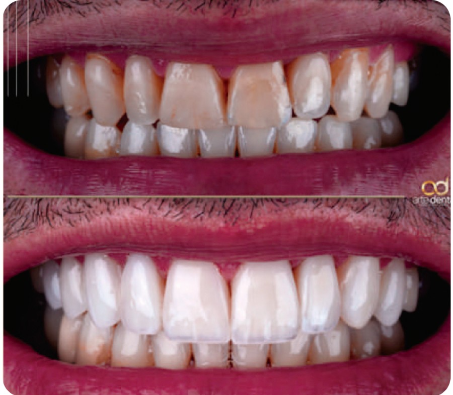 Antes e Depois Facetas de Resina