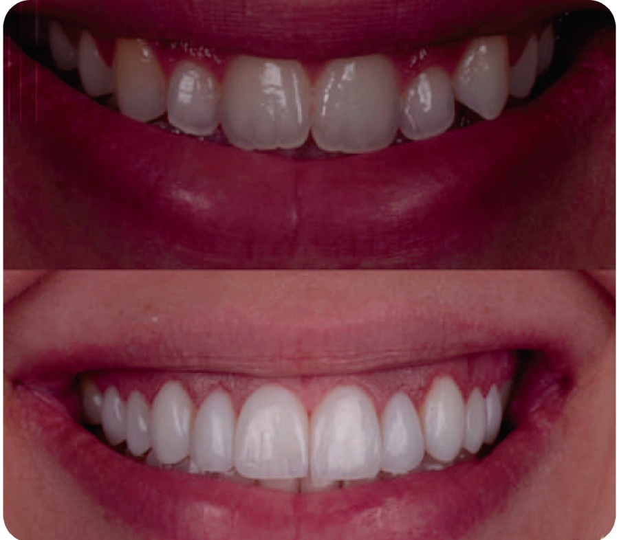 Antes e Depois Facetas de Resina