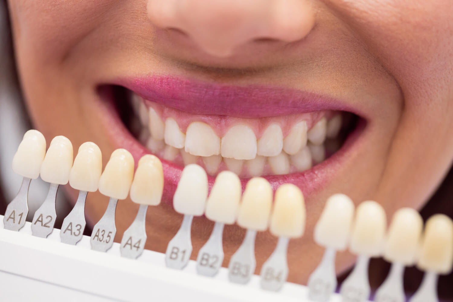 Escala de cores comparada ao sorriso da paciente para aplicação de facetas em resina na Clínica Arte Dental no Tatuapé.