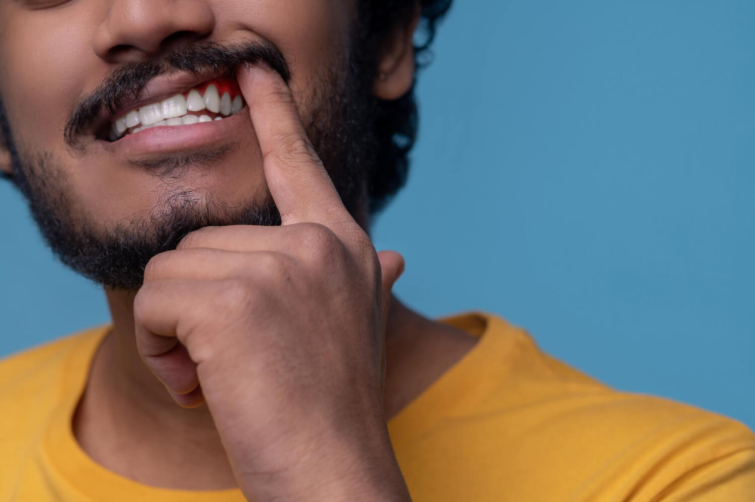 Homem aponta para gengiva inflamada e com sangramento, ilustrando os sintomas da gengivite tratada na Arte Dental Tatuapé.